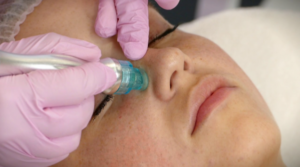 Read more about the article Hydra-Dermabrasion